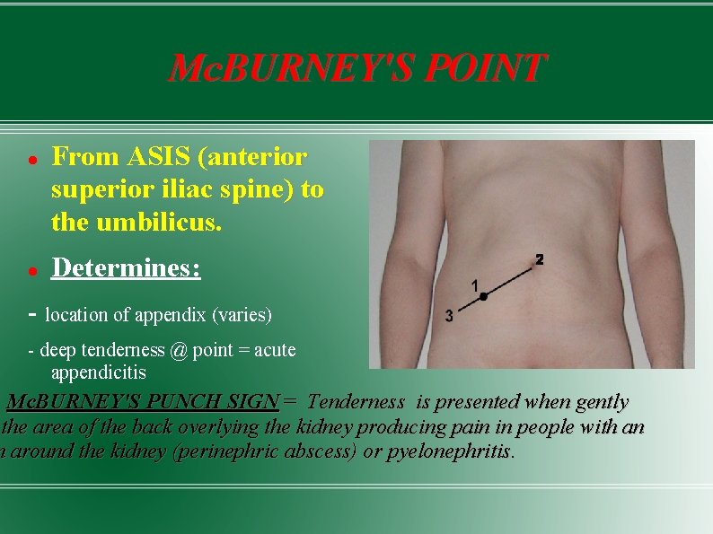 Mc. BURNEY'S POINT From ASIS (anterior superior iliac spine) to the umbilicus. Determines: -