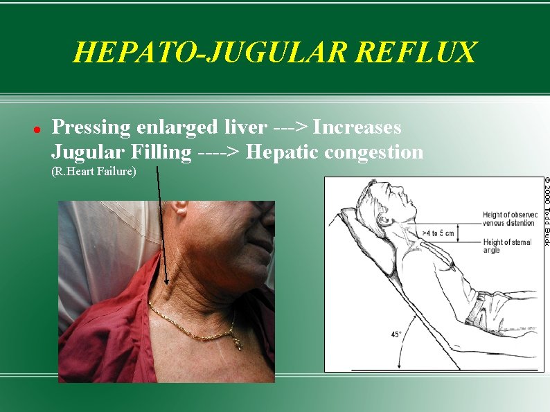 HEPATO-JUGULAR REFLUX Pressing enlarged liver ---> Increases Jugular Filling ----> Hepatic congestion (R. Heart