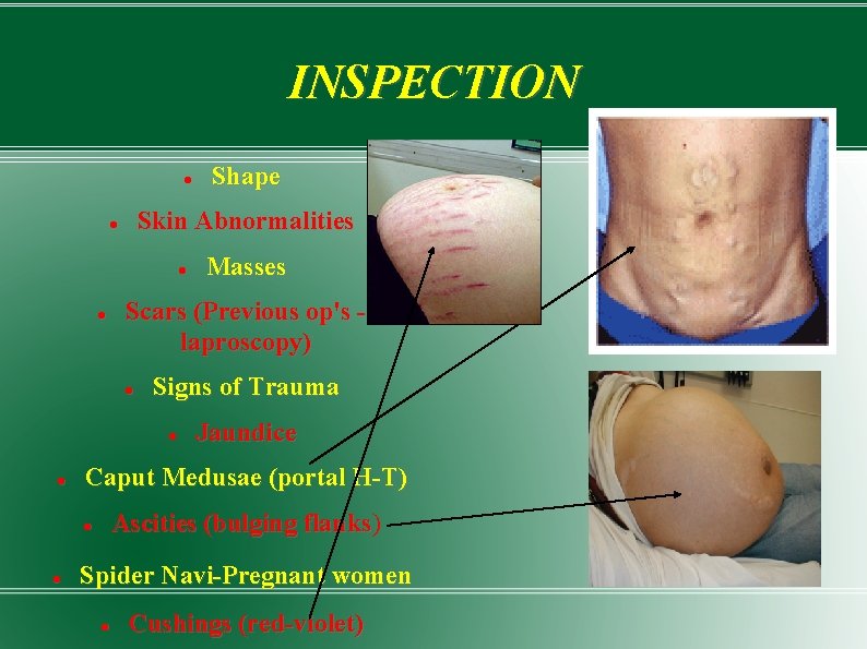 INSPECTION Skin Abnormalities Signs of Trauma Jaundice Caput Medusae (portal H-T) Ascities (bulging flanks)