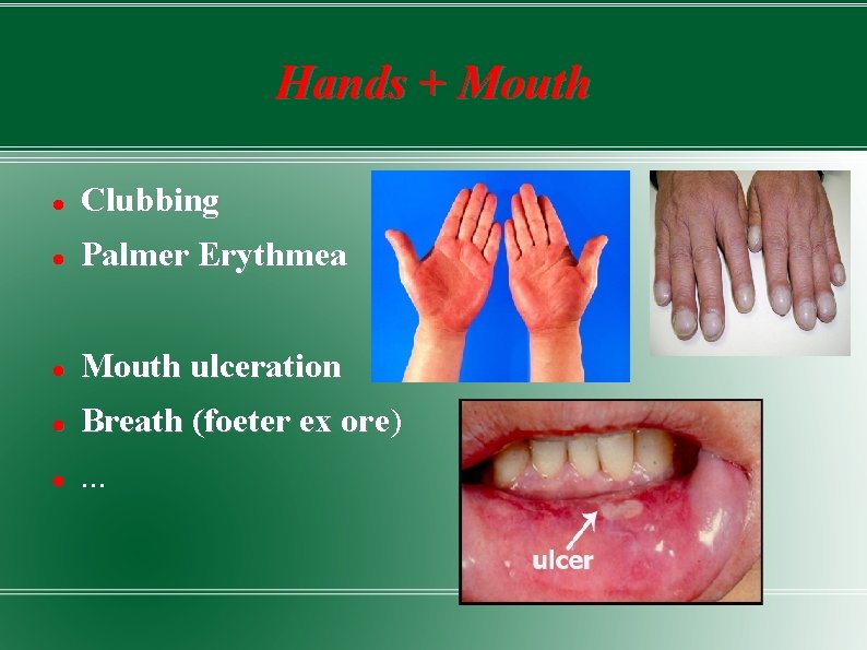 Hands + Mouth Clubbing Palmer Erythmea Mouth ulceration Breath (foeter ex ore) ore .