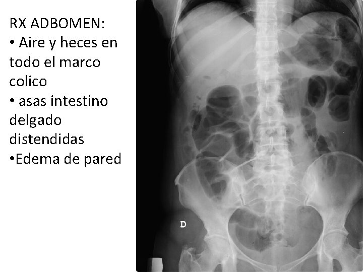 RX ADBOMEN: • Aire y heces en todo el marco colico • asas intestino