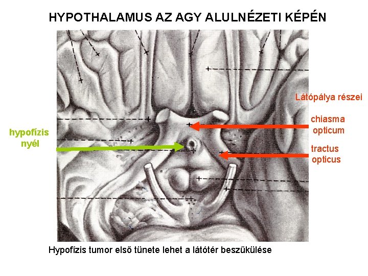 HYPOTHALAMUS AZ AGY ALULNÉZETI KÉPÉN Látópálya részei hypofízis nyél Hypofízis tumor első tünete lehet