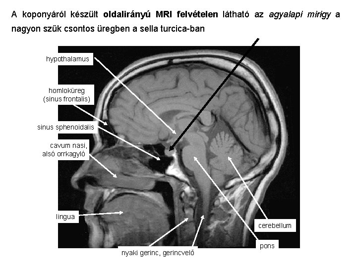 A koponyáról készült oldalirányú MRI felvételen látható az agyalapi mirigy a nagyon szűk csontos