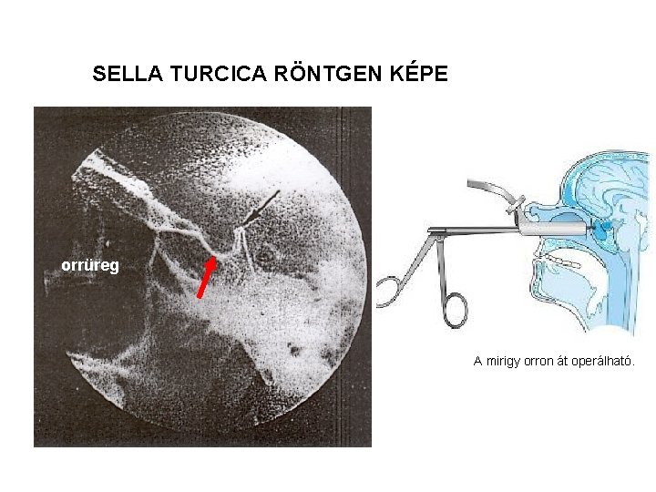 SELLA TURCICA RÖNTGEN KÉPE orrüreg A mirigy orron át operálható. 