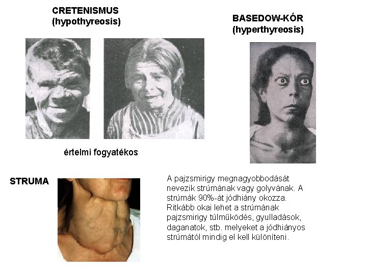 CRETENISMUS (hypothyreosis) BASEDOW-KÓR (hyperthyreosis) értelmi fogyatékos STRUMA A pajzsmirigy megnagyobbodását nevezik strúmának vagy golyvának.