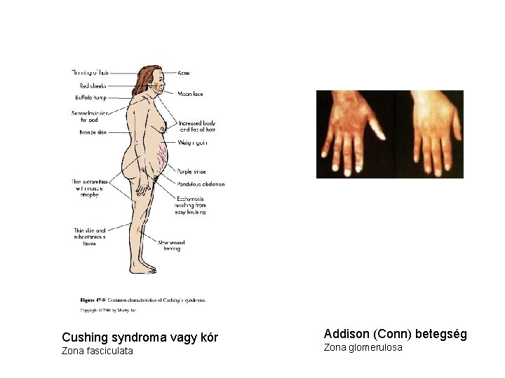 Cushing syndroma vagy kór Zona fasciculata Addison (Conn) betegség Zona glomerulosa 