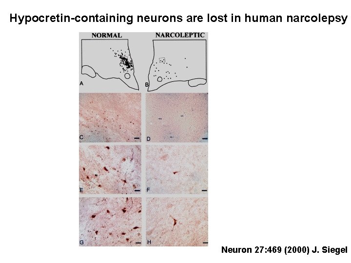 Hypocretin-containing neurons are lost in human narcolepsy Neuron 27: 469 (2000) J. Siegel 