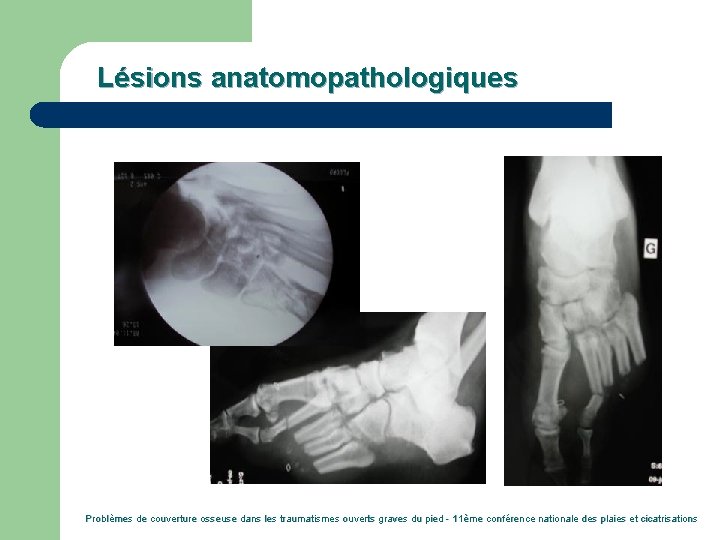 Lésions anatomopathologiques Problèmes de couverture osseuse dans les traumatismes ouverts graves du pied -