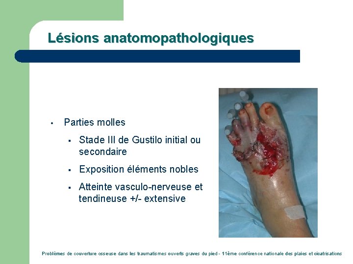 Lésions anatomopathologiques • Parties molles § Stade III de Gustilo initial ou secondaire §