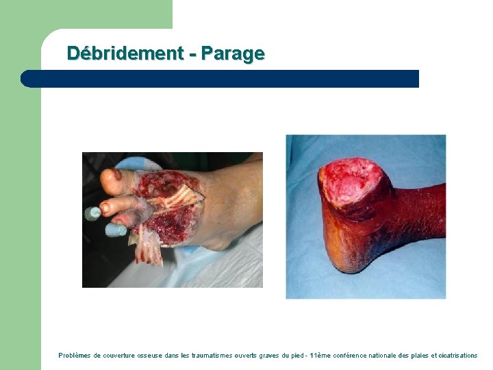 Débridement - Parage Problèmes de couverture osseuse dans les traumatismes ouverts graves du pied