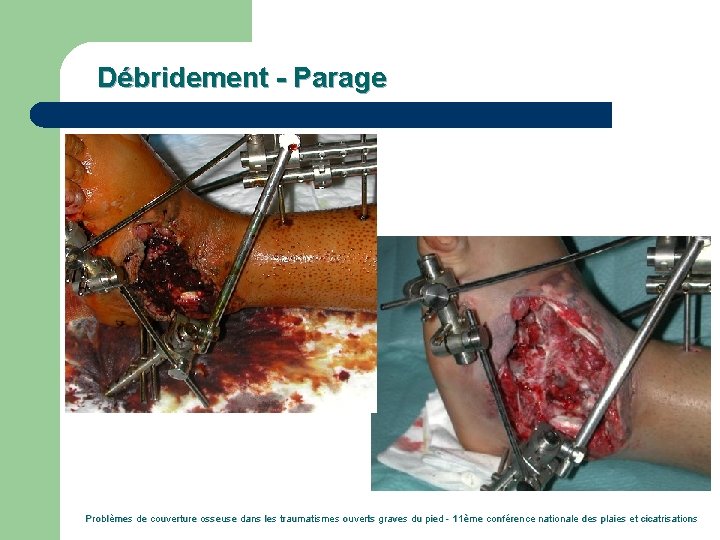 Débridement - Parage Problèmes de couverture osseuse dans les traumatismes ouverts graves du pied