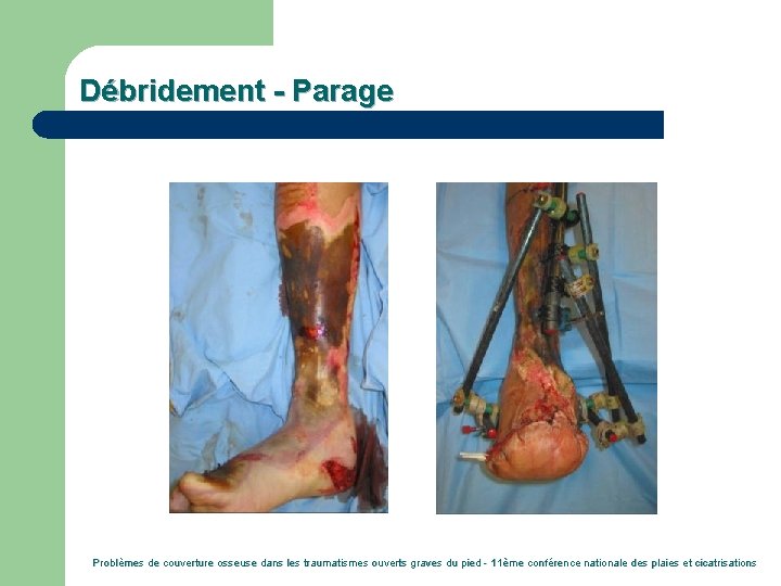 Débridement - Parage Problèmes de couverture osseuse dans les traumatismes ouverts graves du pied