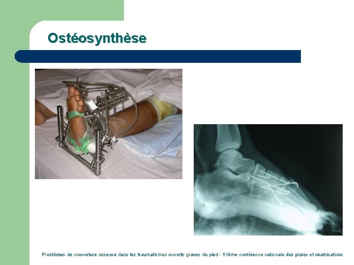 Ostéosynthèse Problèmes de couverture osseuse dans les traumatismes ouverts graves du pied - 11ème