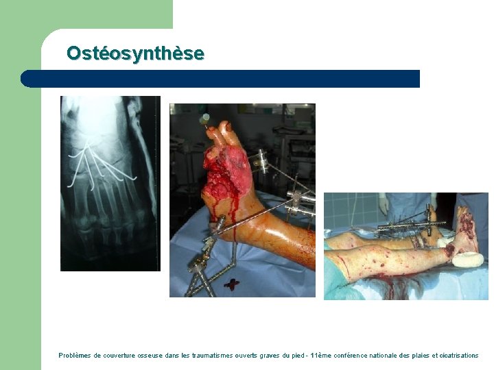 Ostéosynthèse Problèmes de couverture osseuse dans les traumatismes ouverts graves du pied - 11ème