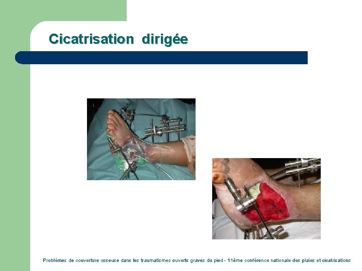 Cicatrisation dirigée Problèmes de couverture osseuse dans les traumatismes ouverts graves du pied -