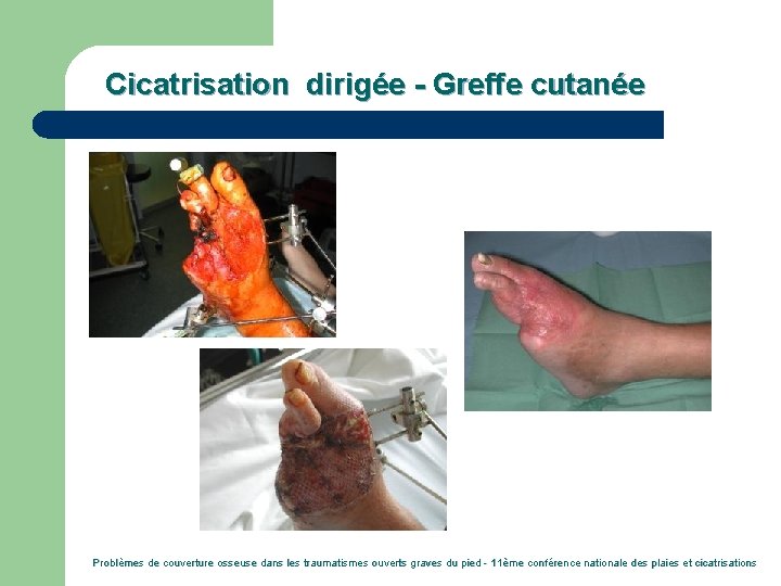 Cicatrisation dirigée - Greffe cutanée Problèmes de couverture osseuse dans les traumatismes ouverts graves