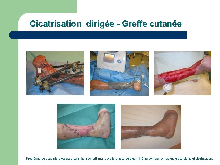 Cicatrisation dirigée - Greffe cutanée Problèmes de couverture osseuse dans les traumatismes ouverts graves