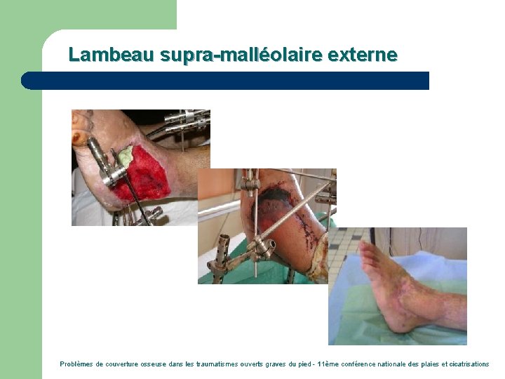 Lambeau supra-malléolaire externe Problèmes de couverture osseuse dans les traumatismes ouverts graves du pied