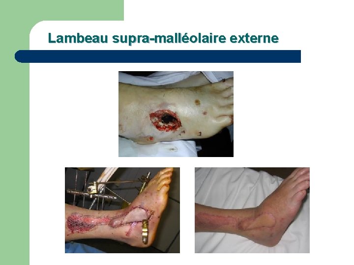 Lambeau supra-malléolaire externe 