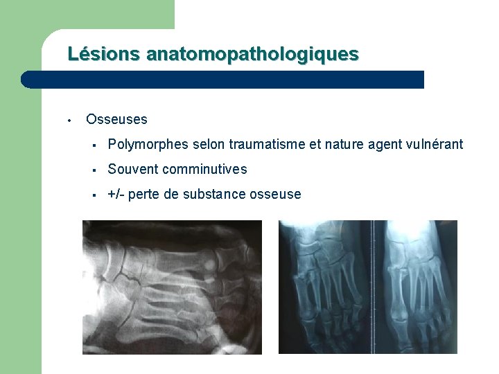 Lésions anatomopathologiques • Osseuses § Polymorphes selon traumatisme et nature agent vulnérant § Souvent