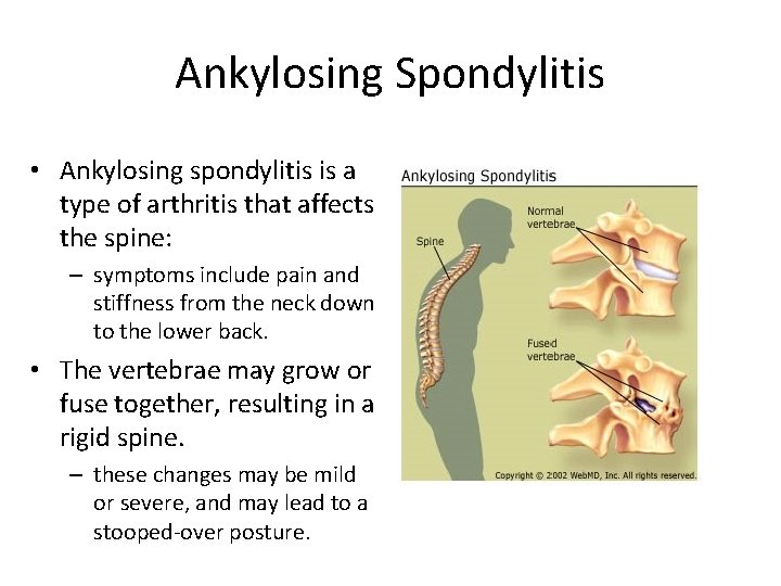 Ankylosing Spondylitis • Ankylosing spondylitis is a type of arthritis that affects the spine: