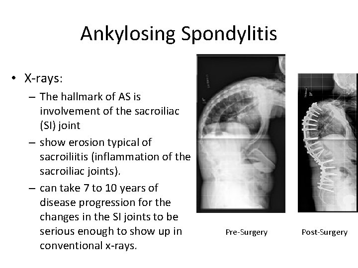 Ankylosing Spondylitis • X-rays: – The hallmark of AS is involvement of the sacroiliac