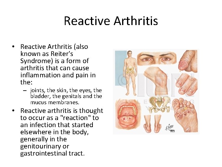 Reactive Arthritis • Reactive Arthritis (also known as Reiter's Syndrome) is a form of