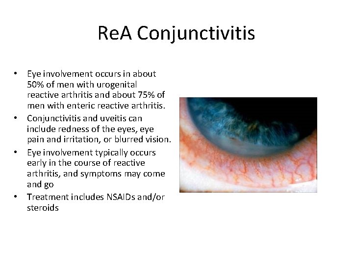 Re. A Conjunctivitis • Eye involvement occurs in about 50% of men with urogenital