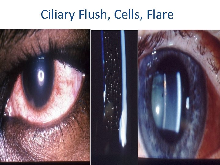 Ciliary Flush, Cells, Flare 