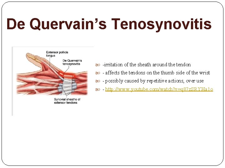 De Quervain’s Tenosynovitis -irritation of the sheath around the tendon - affects the tendons