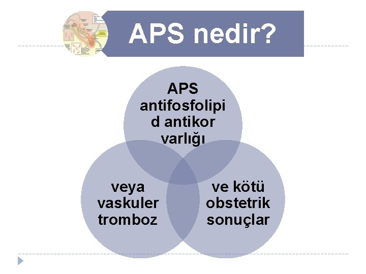 APS nedir? APS antifosfolipi d antikor varlığı veya vaskuler tromboz ve kötü obstetrik sonuçlar