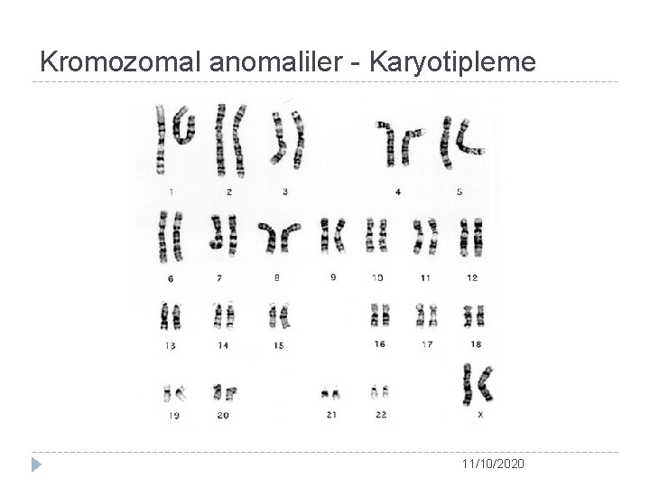 Kromozomal anomaliler - Karyotipleme 11/10/2020 