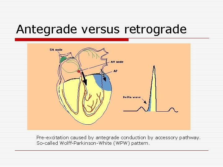Antegrade versus retrograde Pre-excitation caused by antegrade conduction by accessory pathway. So-called Wolff-Parkinson-White (WPW)