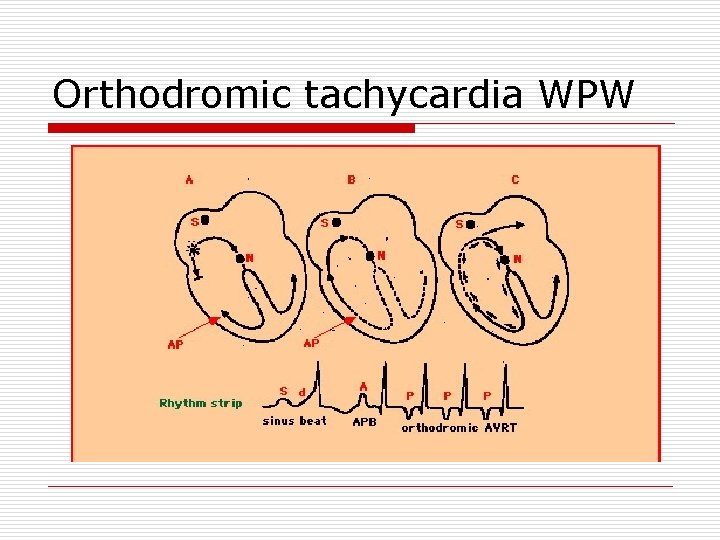 Orthodromic tachycardia WPW 