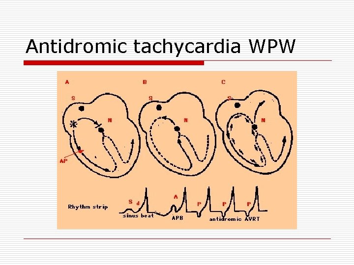 Antidromic tachycardia WPW 