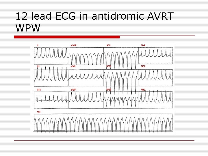 12 lead ECG in antidromic AVRT WPW 