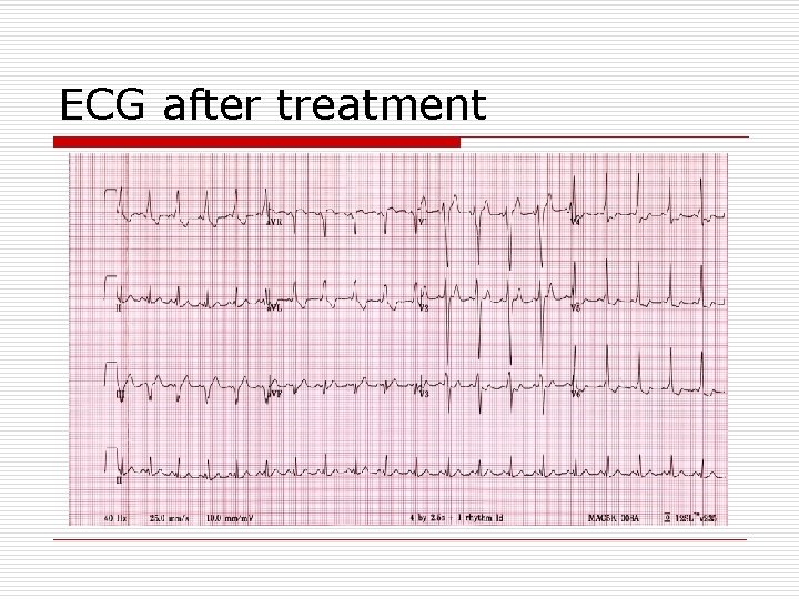 ECG after treatment 