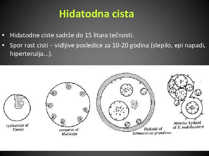 Hidatodna cista • Hidatodne ciste sadrže do 15 litara tečnosti. • Spor rast cisti