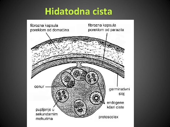 Hidatodna cista 