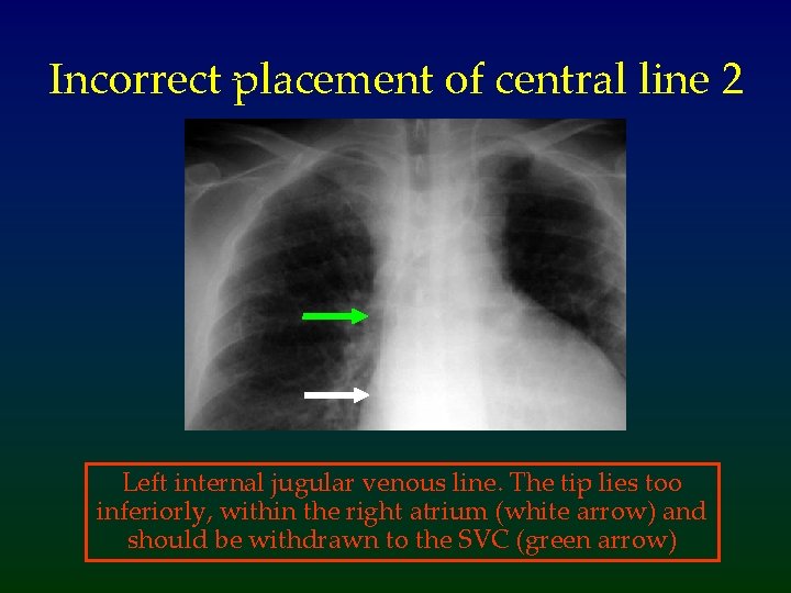 Incorrect placement of central line 2 Left internal jugular venous line. The tip lies