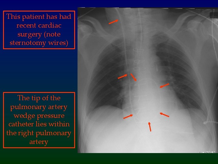 This patient has had recent cardiac surgery (note sternotomy wires) The tip of the
