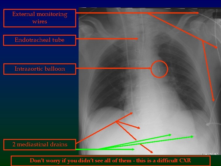 External monitoring wires Endotracheal tube Intraaortic balloon 2 mediastinal drains Don’t worry if you