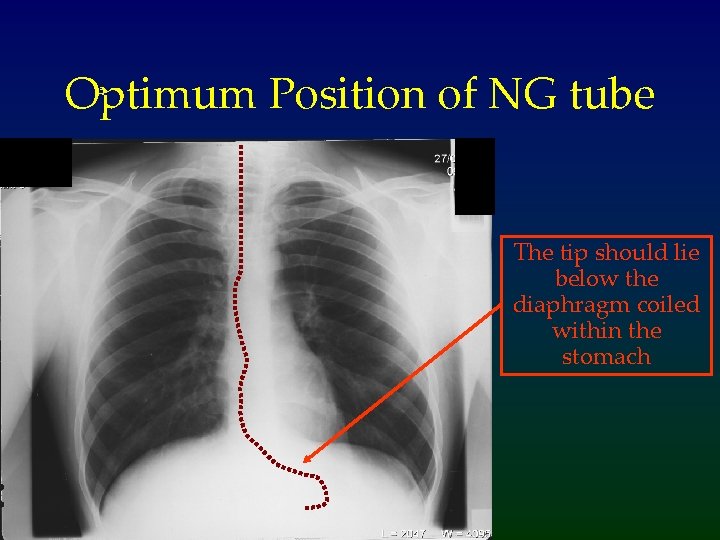 Optimum Position of NG tube The tip should lie below the diaphragm coiled within