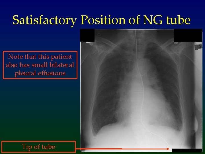 Satisfactory Position of NG tube Note that this patient also has small bilateral pleural