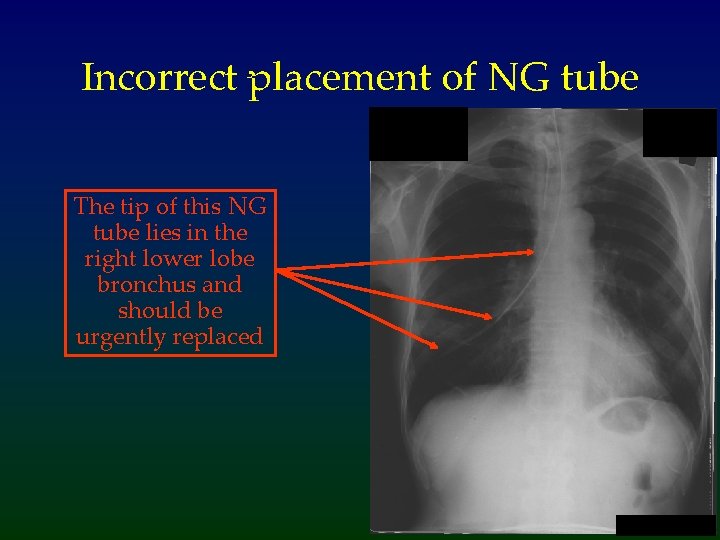 Incorrect placement of NG tube The tip of this NG tube lies in the