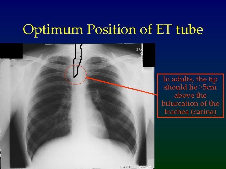 Optimum Position of ET tube In adults, the tip should lie >5 cm above