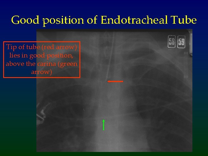 Good position of Endotracheal Tube Tip of tube (red arrow) lies in good position,