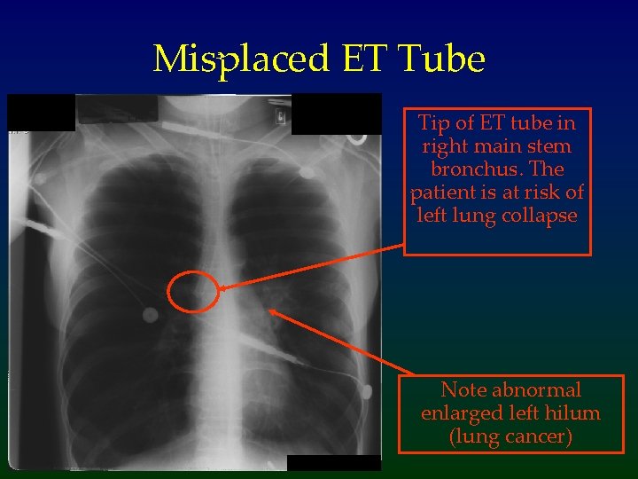 Misplaced ET Tube Tip of ET tube in right main stem bronchus. The patient
