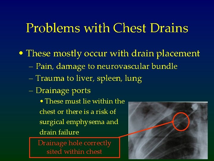 Problems with Chest Drains • These mostly occur with drain placement – Pain, damage