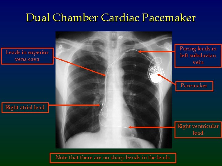 Dual Chamber Cardiac Pacemaker Pacing leads in left subclavian vein Leads in superior vena